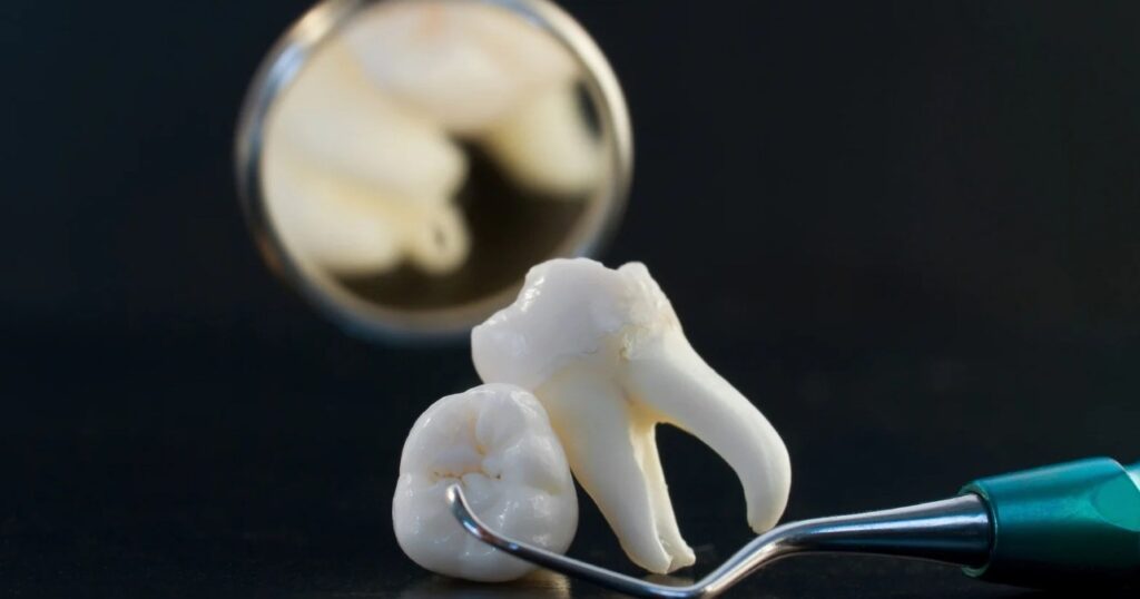 Wisdom Teeth: Do They Really Need to Go? Understanding the Options for Your Third Molars